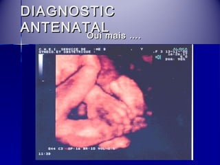 DDIIAAGGNNOOSSTTIICC 
AANNTTEENNAATTAALL OOuuii mmaaiiss …….. 
 