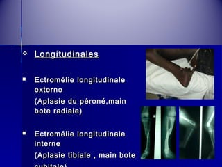  LLoonnggiittuuddiinnaalleess 
 EEccttrroomméélliiee lloonnggiittuuddiinnaallee 
eexxtteerrnnee 
((AAppllaassiiee dduu ppéérroonnéé,,mmaaiinn 
bboottee rraaddiiaallee)) 
 EEccttrroomméélliiee lloonnggiittuuddiinnaallee 
iinntteerrnnee 
((AAppllaassiiee ttiibbiiaallee ,, mmaaiinn bboottee 
ccuubbiittaallee)) 
 