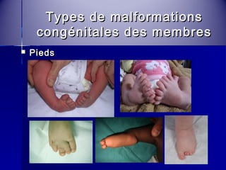 Types ddee mmaallffoorrmmaattiioonnss 
ccoonnggéénniittaalleess ddeess mmeemmbbrreess 
 PPiieeddss 
 