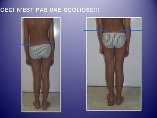 CECI N’EST PAS UNE SCOLIOSE!!! 
 