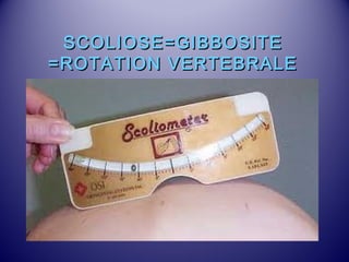 SSCCOOLLIIOOSSEE==GGIIBBBBOOSSIITTEE 
==RROOTTAATTIIOONN VVEERRTTEEBBRRAALLEE 
 