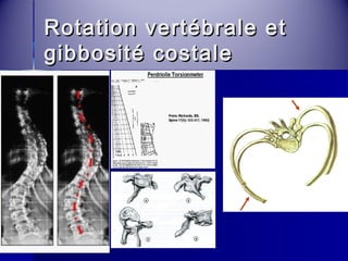 Rotation vveerrttéébbrraallee eett 
ggiibbbboossiittéé ccoossttaallee 
 