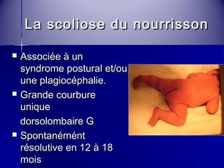 La scoliose dduu nnoouurrrriissssoonn 
 AAssssoocciiééee àà uunn 
ssyynnddrroommee ppoossttuurraall eett//oouu 
uunnee ppllaaggiiooccéépphhaalliiee.. 
 GGrraannddee ccoouurrbbuurree 
uunniiqquuee 
ddoorrssoolloommbbaaiirree GG 
 SSppoonnttaannéémméénntt 
rrééssoolluuttiivvee eenn 1122 àà 1188 
mmooiiss 
 