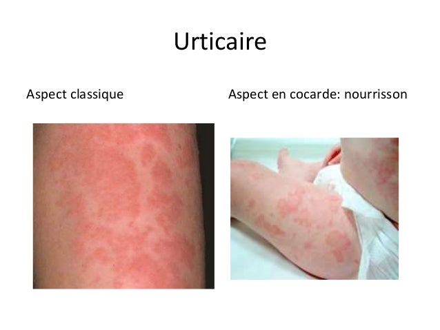 Pathologies Allergiques Du Jeune Enfant