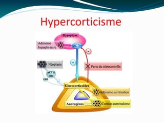 Hypercorticisme
 