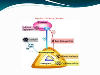 ETIOLOGIES DE L’HYPERCORTICISME
 