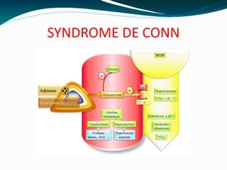SYNDROME DE CONN
 