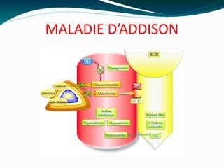 MALADIE D’ADDISON
 