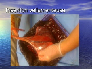 Insertion vellamenteuse 