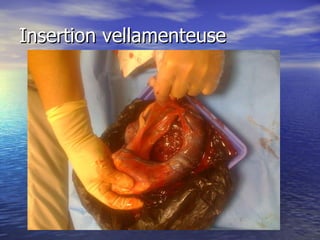 Insertion vellamenteuse 