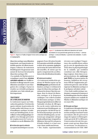 PATHOLOGIES NON ATHÉROMATEUSES DES TRONCS SUPRA-AORTIQUES
       DOSSIER FMC
détachable




                                                                                           Figure 5 - Localisation des différents diamètres de l’aorte
                                                                                           ascendante en vue parasternale grand axe au niveau : 1. anneau
                         Figure 4 - Aspect en “bulbe d’oignon” de la racine aortique vue   aortique ; 2. sinus de Valsalva ; 3. jonction sino-tubulaire ; 4. aorte
                         en angiographie.                                                  ascendante.


                         dissection aortique sans dilatation           pagnant d’une élévation brutale                 récentes ont souligné l’impor-
                         importante, une hypertension ar-              de la pression artérielle systolique            tance des modifications subies
                         térielle associée, les efforts isomé-         et donc de la contrainte appliquée              par la voie de signalisation des
                         triques, l’absence de traitement              sur la racine de l’aorte doivent être           TGFβ dans la physiopathologie
                         bêtabloquant et la grossesse sont             déconseillés, de même que les                   de la maladie, qui semblent
                         autant de facteurs favorisant la              sports comportant des accéléra-                 constituer une cible thérapeu-
                         dissection aortique (22).                     tions et des décélérations brutales.            tique majeure. Ainsi, dans ces ex-
                         • La maladie de Marfan peut se                                                                périmentations des anticorps
                         compliquer aussi d’une atteinte               ■ Traitement médical                                      β
                                                                                                                       anti-TGFβ ou la prescription de
                         valvulaire mitrale avec feuillet re-          • Le traitement médical du syn-                 losartan, inhibiteur des récep-
                         dondant et allongé associée à une             drome de Marfan repose sur les                  teurs ATII de l’angiotensine per-
                         dilatation annulaire et une élon-             bêtabloquants qui limitent la di-               mettent de prévenir, voire de faire
                         gation des cordages. Il peut en               latation aortique et réduisent le               régresser la dilatation aortique et
                         résulter un véritable prolapsus               risque de dissection aortique, di-              le prolapsus valvulaire mitral.
                         valvulaire avec fuite mitrale par-            minuent la vitesse d’éjection aor-              • Une étude multicentrique ran-
                         fois importante.                              tique, donc la vitesse de disten-               domisée comparant le losartan et
                                                                       sion aortique et la fréquence                   les bêtabloquants chez les enfants
                         TRAITEMENT                                    cardiaque c’est-à-dire le nombre                et jeunes adultes avec maladie de
                         DE LA MALADIE DE MARFAN                       de distension aortique. Le bêta-                Marfan et dilatation aortique est
                         Le traitement repose sur l’édu-               bloquant généralement utilisé est               en cours (25).
                         cation des patients, l’éviction des           l’aténolol, à la dose de 100 mg/j.
                         sports violents, la prévention de             En cas de contre-indication au                  ■ Chirurgie aortique
                         l’endocardite infectieuse en cas              traitement par bêtabloquant, on                 Le traitement chirurgical doit être
                         d’insuffisance aortique, le traite-           peut proposer, du fait de leur ef-              réalisé en urgence en cas de dis-
                         ment par bêtabloquants, la sur-               fet hémodynamique proche de                     section aortique touchant l’aorte
                         veillance échocardiographique ré-             celui des bêtabloquants, un trai-               ascendante afin de prévenir le
                         gulière et la chirurgie préventive            tement par antagoniste calcique                 risque de rupture et d’hémopéri-
                         de remplacement de l’aorte as-                bradycardisant type vérapamil ou                carde qui est de 50 % à 48 heures.
                         cendante en cas de dilatation (23).           diltiazem, bien qu’il n’y ait pas eu            L’intervention devrait être pro-
                                                                       d’étude réalisée à ce jour avec                 posée avant qu’une dissection
                         ■ Eviction des sports violents                cette classe médicamenteuse.                    ne survienne. Les dernières re-
                         Les sports isométriques s’accom-              • Des études expérimentales                     commandations de l’ESC 2007

                         214                                                                                        Cardiologie - Cardinale • Mai 2010 • vol. 4 • numéro 29
 