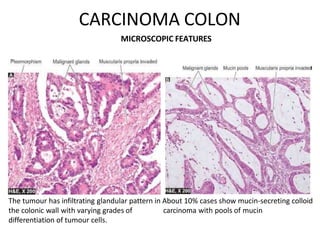 CARCINOMA COLON
MICROSCOPIC FEATURES
The tumour has infiltrating glandular pattern in About 10% cases show mucin-secreting colloid
the colonic wall with varying grades of carcinoma with pools of mucin
differentiation of tumour cells.
 