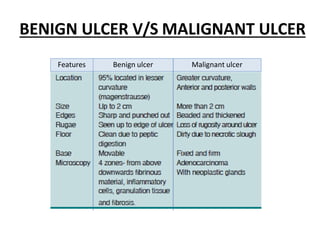 BENIGN ULCER V/S MALIGNANT ULCER
Features Benign ulcer Malignant ulcer
 