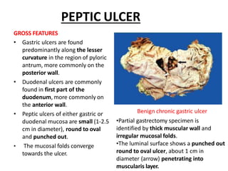 PEPTIC ULCER
GROSS FEATURES
• Gastric ulcers are found
predominantly along the lesser
curvature in the region of pyloric
antrum, more commonly on the
posterior wall.
• Duodenal ulcers are commonly
found in first part of the
duodenum, more commonly on
the anterior wall.
• Peptic ulcers of either gastric or
duodenal mucosa are small (1-2.5
cm in diameter), round to oval
and punched out.
• The mucosal folds converge
towards the ulcer.
Benign chronic gastric ulcer
•Partial gastrectomy specimen is
identified by thick muscular wall and
irregular mucosal folds.
•The luminal surface shows a punched out
round to oval ulcer, about 1 cm in
diameter (arrow) penetrating into
muscularis layer.
 