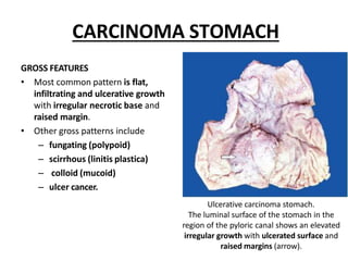 CARCINOMA STOMACH
GROSS FEATURES
• Most common pattern is flat,
infiltrating and ulcerative growth
with irregular necrotic base and
raised margin.
• Other gross patterns include
– fungating (polypoid)
– scirrhous (linitis plastica)
– colloid (mucoid)
– ulcer cancer.
Ulcerative carcinoma stomach.
The luminal surface of the stomach in the
region of the pyloric canal shows an elevated
irregular growth with ulcerated surface and
raised margins (arrow).
 
