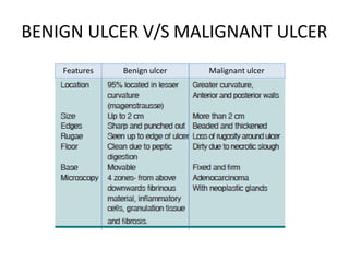 BENIGN ULCER V/S MALIGNANT ULCER
Features Benign ulcer Malignant ulcer
 