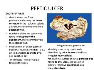PEPTIC ULCER
GROSS FEATURES
• Gastric ulcers are found
predominantly along the lesser
curvature in the region of pyloric
antrum, more commonly on the
posterior wall.
• Duodenal ulcers are commonly
found in first part of the
duodenum, more commonly on
the anterior wall.
• Peptic ulcers of either gastric or
duodenal mucosa are small (1-2.5
cm in diameter), round to oval
and punched out.
• The mucosal folds converge
towards the ulcer.
Benign chronic gastric ulcer
•Partial gastrectomy specimen is
identified by thick muscular wall and
irregular mucosal folds.
•The luminal surface shows a punched out
round to oval ulcer, about 1 cm in
diameter (arrow) penetrating into
muscularis layer.
 