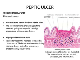 PEPTIC ULCER
MICROSCOPIC FEATURES
4 histologic zones
1. Necrotic zone lies in the floor of the ulcer
• The tissue elements show coagulative
necrosis giving eosinophilic smudgy
appearance with nuclear debris.
g
2. Superficial exudative zone
• lies underneath the necrotic zone and is
composed of fibrinous exudate containin
necrotic debris and a few leucocytes,
predominantly neutrophils. Chronic peptic ulcer
Histologic zones of the ulcer are illustrated.
The mucosal surface shows necrosis,
ulceration, and inflammation.
 
