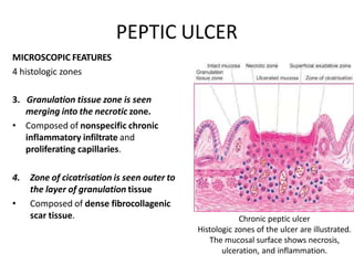 PEPTIC ULCER
MICROSCOPIC FEATURES
4 histologic zones
3. Granulation tissue zone is seen
merging into the necrotic zone.
• Composed of nonspecific chronic
inflammatory infiltrate and
proliferating capillaries.
4. Zone of cicatrisation is seen outer to
the layer of granulation tissue
• Composed of dense fibrocollagenic
scar tissue. Chronic peptic ulcer
Histologic zones of the ulcer are illustrated.
The mucosal surface shows necrosis,
ulceration, and inflammation.
 