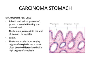 CARCINOMA STOMACH
MICROSCOPIC FEATURES
• Tubular and acinar pattern of
growth is seen infiltrating the
stomach wall.
• The tumour invades into the wall
of stomach for variable
• depth.
• The tumour cells show varying
degree of anaplasia but is more
often poorly-differentiated with
high degree of anaplasia
 