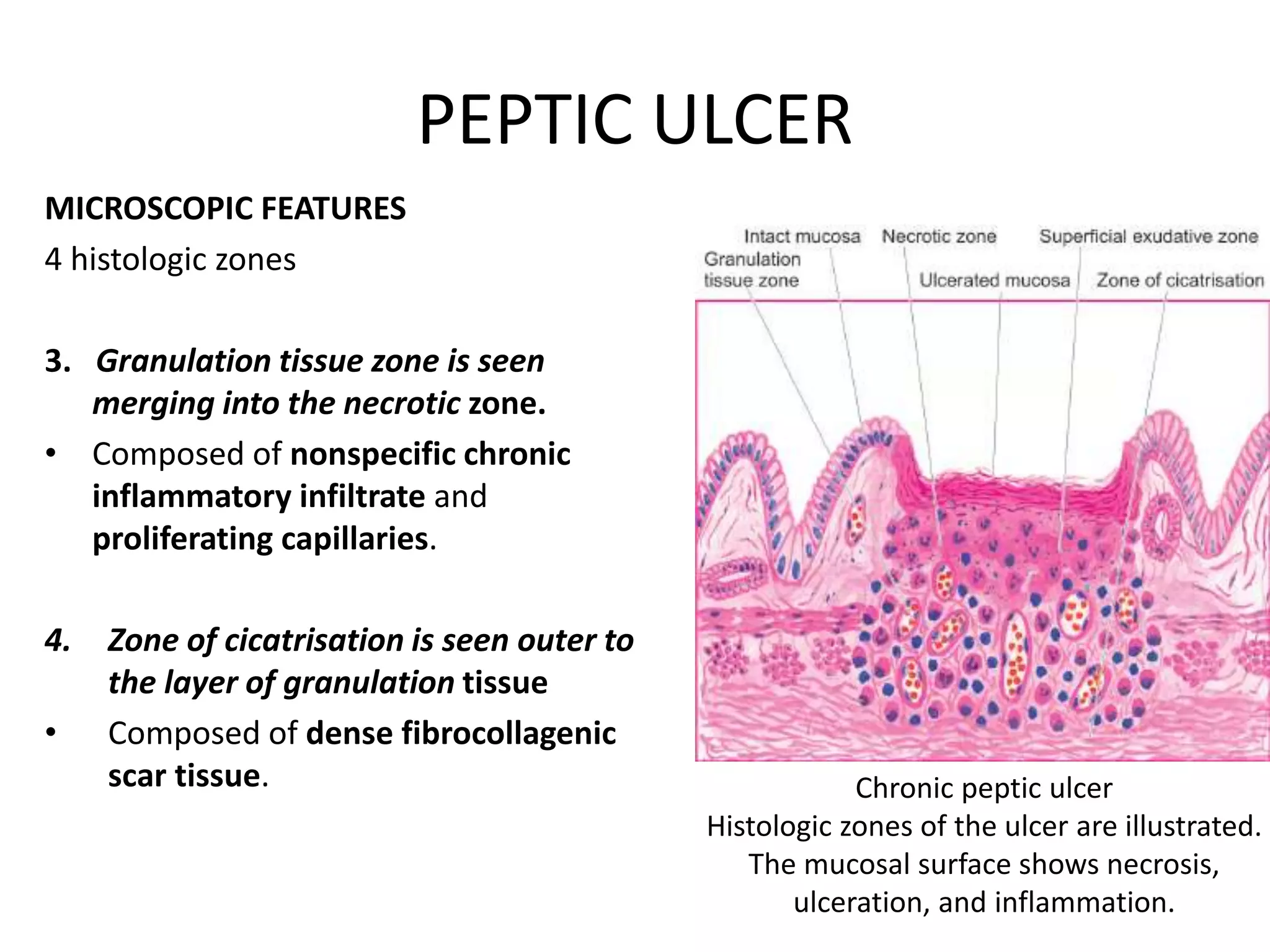 PEPTIC ULCER
MICROSCOPIC FEATURES
4 histologic zones
3. Granulation tissue zone is seen
merging into the necrotic zone.
• Composed of nonspecific chronic
inflammatory infiltrate and
proliferating capillaries.
4. Zone of cicatrisation is seen outer to
the layer of granulation tissue
• Composed of dense fibrocollagenic
scar tissue. Chronic peptic ulcer
Histologic zones of the ulcer are illustrated.
The mucosal surface shows necrosis,
ulceration, and inflammation.
 