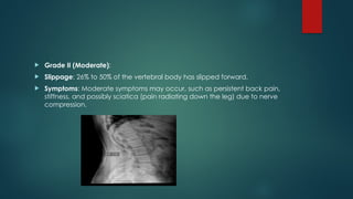 Slipped Forward Introduction to Pathologies of the spine-1.pptx
