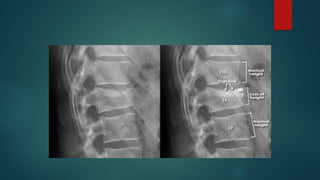 Vertebral Pathologies Introduction to Pathologies of the spine-1.pptx