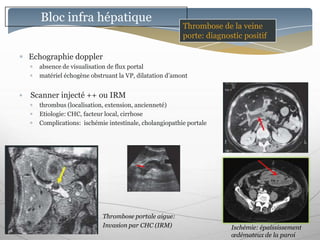 Bloc infra hépatique
                                                     Thrombose de la veine
                                                     porte: diagnostic positif

Echographie doppler
  absence de visualisation de flux portal
  matériel échogène obstruant la VP, dilatation d’amont


Scanner injecté ++ ou IRM
  thrombus (localisation, extension, ancienneté)
  Etiologie: CHC, facteur local, cirrhose
  Complications: ischémie intestinale, cholangiopathie portale




                        Thrombose portale aigue:
                        Invasion par CHC (IRM)                     Ischémie: épaississement
                                                                   œdémateux de la paroi
 
