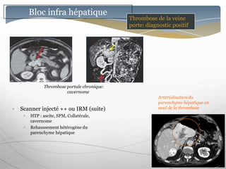 Bloc infra hépatique
                                         Thrombose de la veine
                                         porte: diagnostic positif




          Thrombose portale chronique:
                    cavernome
                                                     Artérialisation du
                                                     parenchyme hépatique en
Scanner injecté ++ ou IRM (suite)                    aval de la thrombose
   HTP : ascite, SPM, Collatérale,
   cavernome
   Rehaussement hétérogène du
   parenchyme hépatique
 