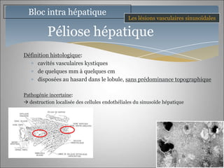Bloc intra hépatique
                                               Les lésions vasculaires sinusoïdales

          Péliose hépatique
Définition histologique:
     cavités vasculaires kystiques
     de quelques mm à quelques cm
     disposées au hasard dans le lobule, sans prédominance topographique

Pathogénie incertaine:
 destruction localisée des cellules endothéliales du sinusoïde hépatique
 