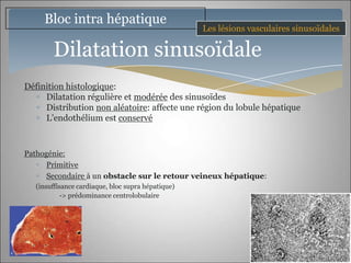 Bloc intra hépatique
                                                    Les lésions vasculaires sinusoïdales

        Dilatation sinusoïdale
Définition histologique:
     Dilatation régulière et modérée des sinusoïdes
     Distribution non aléatoire: affecte une région du lobule hépatique
     L’endothélium est conservé



Pathogénie:
      Primitive
      Secondaire à un obstacle sur le retour veineux hépatique:
   (insuffisance cardiaque, bloc supra hépatique)
            -> prédominance centrolobulaire
 