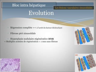 Bloc intra hépatique
                                                     Les lésions vasculaires sinusoïdales

                         Evolution

      Régression complète ++ à l’arrêt du facteur déclenchant

      Fibrose péri sinusoïdale

      Hyperplasie nodulaire régénérative HNR
= Multiples nodules de régénération < 1 mm sans fibrose
 