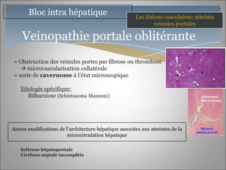 Bloc intra hépatique                             Les lésions vasculaires: atteinte
                                                                veinules portales

    Veinopathie portale oblitérante
= Obstruction des veinules portes par fibrose ou thrombose
    microvascularisation collatérale
= sorte de cavernome à l’état microscopique

   Etiologie spécifique:
      Bilharziose (Schistosoma Mansoni)




Autres modifications de l’architecture hépatique associées aux atteintes de la
                         microcirculation hépatique

   Sclérose hépatoportale
   Cirrhose septale incomplète
 