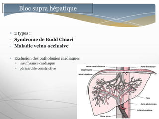 Bloc supra hépatique


  2 types :
- Syndrome de Budd Chiari
- Maladie veino occlusive

 Exclusion des pathologies cardiaques
   insuffisance cardiaque
   péricardite constrictive
 