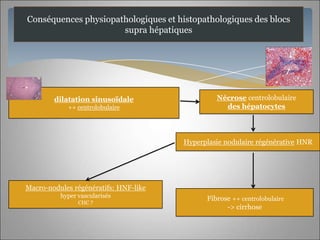Conséquences physiopathologiques et histopathologiques des blocs
                      supra hépatiques




        dilatation sinusoïdale                  Nécrose centrolobulaire
            ++ centrolobulaire                    des hépatocytes




                                       Hyperplasie nodulaire régénérative HNR




Macro-nodules régénératifs: HNF-like
          hyper vascularisés                 Fibrose ++ centrolobulaire
                CHC ?
                                                   -> cirrhose
 