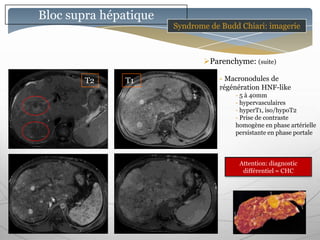 Bloc supra hépatique
                       Syndrome de Budd Chiari: imagerie



                              Parenchyme: (suite)

        T2     T1                  - Macronodules de
                                   régénération HNF-like
                                       - 5 à 40mm
                                       - hypervasculaires
                                       - hyperT1, iso/hypoT2
                                       - Prise de contraste
                                       homogène en phase artérielle
                                       persistante en phase portale



                                        Attention: diagnostic
                                         différentiel = CHC
 