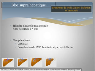 Bloc supra hépatique
                                                                         Syndrome de Budd Chiari: évolution
                                                                                   et pronostic




                Histoire naturelle mal connue
                80% de survie à 5 ans



                Complications:
                       CHC (rare)
                       Complication du SMP: Leucémie aigue, myelofibrose




DELEVE LD, VALLA DC, GARCIA TSAO G. Vascular disorders of the liver. AASLD Practice Guidelines. Hepatology, 2009
 