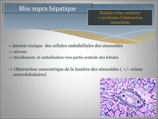 Bloc supra hépatique
                                                    Maladie veino occlusive
                                                   = syndrome d’obstruction
                                                          sinusoïdale




= atteinte toxique des cellules endothéliales des sinusoïdes
-> nécrose
-> décollement, et embolisation vers partie centrale des lobules


-> Obstruction concentrique de la lumière des sinusoïdes ( +/- veines
  centrolobulaires)
 