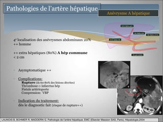 Pathologies de l’artère hépatique
                                                                                      Anévrysme A hépatique




         4e localisation des anévrysmes abdominaux 20%
         ++ homme

         ++ extra hépatiques (80%) A hép commune
         < 2 cm


             Asymptomatique ++

             Complications:
                Rupture (ds 60-80% des lésions décrites)
                Thrombose-> infarctus hép
                Fistule artérioporte
                Compression: VBP

             Indication du traitement:
             dès le diagnostic fait (risque de rupture++)


LAUNOIS B, BOHMER R, MADDERN G. Pathologie de l’artère hépatique. EMC (Elsevier Massion SAS, Paris), Hépatologie,2004
 