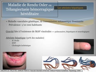 Maladie de Rendu Osler ou
                                                                               Les atteintes hépatiques
      Télangiectasie hémorragique
              héréditaire
      = Maladie vasculaire génétique, de transmission autosomique dominante
        Prévalence: 1/10 000 habitants

      Gravité liée à l’existence de MAV viscérales ++ pulmonaires, hépatiques et neurologiques

      Atteinte hépatique (30% des malades)
               IC droite
               HTP
               Cholangite ischémique




DELEVE LD, VALLA DC, GARCIA TSAO G. Vascular disorders of the liver. AASLD Practice Guidelines. Hepatology, 2009
 