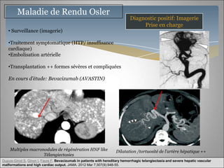 Maladie de Rendu Osler
                                                                              Diagnostic positif: Imagerie
                                                                                   Prise en charge
   • Surveillance (imagerie)

   •Traitement symptomatique (HTP/ insuffisance
   cardiaque)
   •Embolisation artérielle

   •Transplantation ++ formes sévères et compliquées

   En cours d’étude: Bevacizumab (AVASTIN)




    Multiples macronodules de régénération HNF like                  Dilatation /tortuosité de l’artère hépatique ++
                    Télangiectasies
Dupuis-Girod S, Ginon I, Faure F. Bevacizumab in patients with hereditary hemorrhagic telangiectasia and severe hepatic vascular
malformations and high cardiac output. JAMA. 2012 Mar 7;307(9):948-55.
 