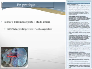 En pratique…



Penser à Thrombose porte + Budd Chiari

  Intérêt diagnostic précoce  anticoagulation
 