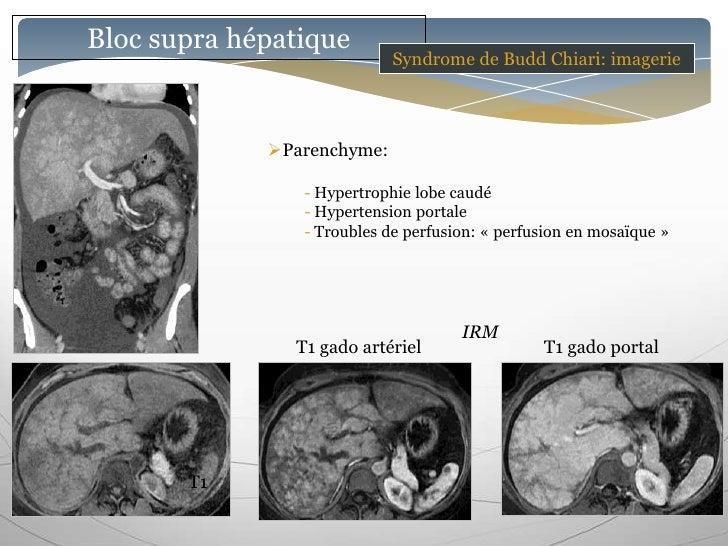 Pathologies vasculaires du foie