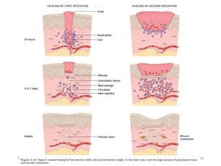 PATHOLOGY - lecture - Healing & Repair.pdf