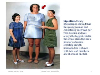 Tuesday, July 30, 2024 Ephraim Zulu - PATHOLOGY 13
Gigantism. Family
photographs showed that
this young woman had
consistently outgrown her
twin brother and was
always the biggest child in
the school class. She had a
pituitary adenoma
secreting growth
hormone. She is shown
with two staff members,
one short and one tall.
 