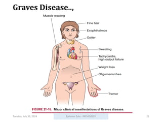 Tuesday, July 30, 2024 Ephraim Zulu - PATHOLOGY 21
Graves Disease..,
 