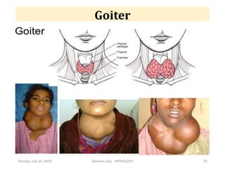 Tuesday, July 30, 2024 Ephraim Zulu - PATHOLOGY 25
Goiter
 