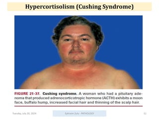 Hypercortisolism (Cushing Syndrome)
Tuesday, July 30, 2024 Ephraim Zulu - PATHOLOGY 51
 