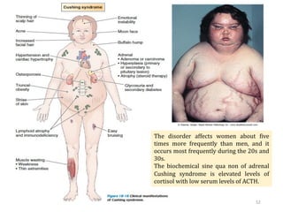 Tuesday, July 30, 2024 Ephraim Zulu - PATHOLOGY 52
The disorder affects women about five
times more frequently than men, and it
occurs most frequently during the 20s and
30s.
The biochemical sine qua non of adrenal
Cushing syndrome is elevated levels of
cortisol with low serum levels of ACTH.
 