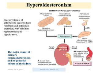 Tuesday, July 30, 2024 Ephraim Zulu - PATHOLOGY 54
The major causes of
primary
hyperaldosteronism
and its principal
effects on the kidney
Hyperaldosteronism
Excessive levels of
aldosterone cause sodium
retention and potassium
excretion, with resultant
hypertension and
hypokalemia.
 